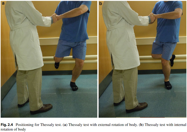 试验(thessaly test) 膝伸直位,强力被动内收或外展膝部,如有半月板