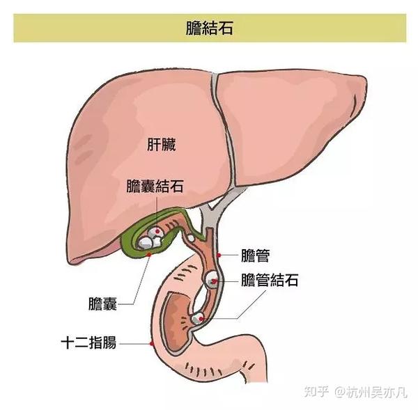 胆结石如何形成?