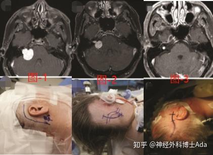 听神经瘤治疗方法怎么选?临床分期及手术要点解析