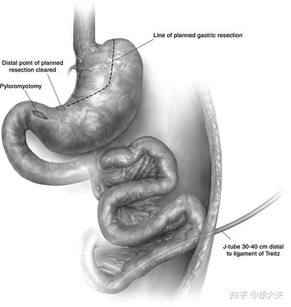 管状胃制作,幽门成型,空肠造瘘术