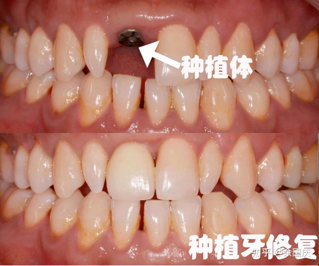 种植牙和根管后套上牙冠的牙齿有何区别