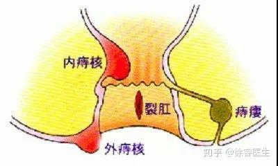 从内痔ii期开始,患者在平时便会出现脱出的症状