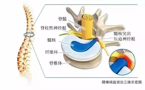 得了椎间盘突出怎么办?腰椎间盘怎么恢复,说说我的康复之路