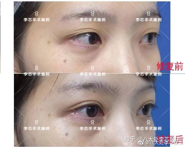 等线脱落了,很多爱美者会出现多层眼皮的情况,与其说修复,不如说重新