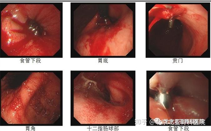 贲门十二点方向齿状线可见粘膜撕裂,检查诊断:贲门粘膜撕裂综合征并