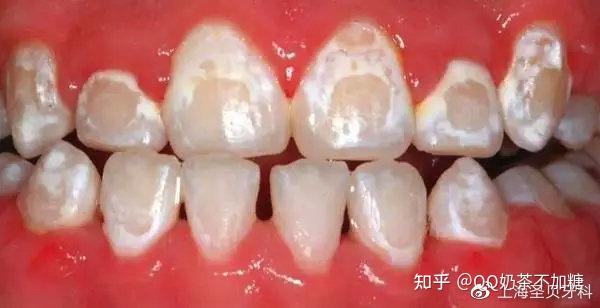 其实也就是说明,你的牙齿外层的牙釉质有点蛀牙了.