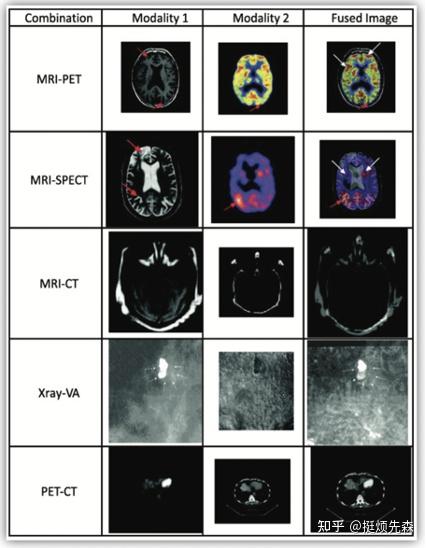 mri中有t1wi,t2wi,flair,swi,pwi,swan,灌注dsc等不同序列图像;pet