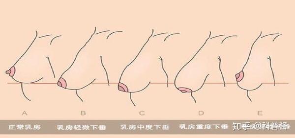 遇到胸下垂,该怎么办?别慌有办法!