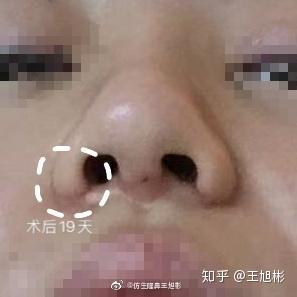 鼻整形科普:鼻翼缩小一定会出现疤痕增生,那还要不要缩鼻翼?