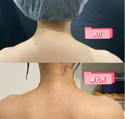 医美小白入门体验瘦肩针的感受姐妹们我终于不溜肩了