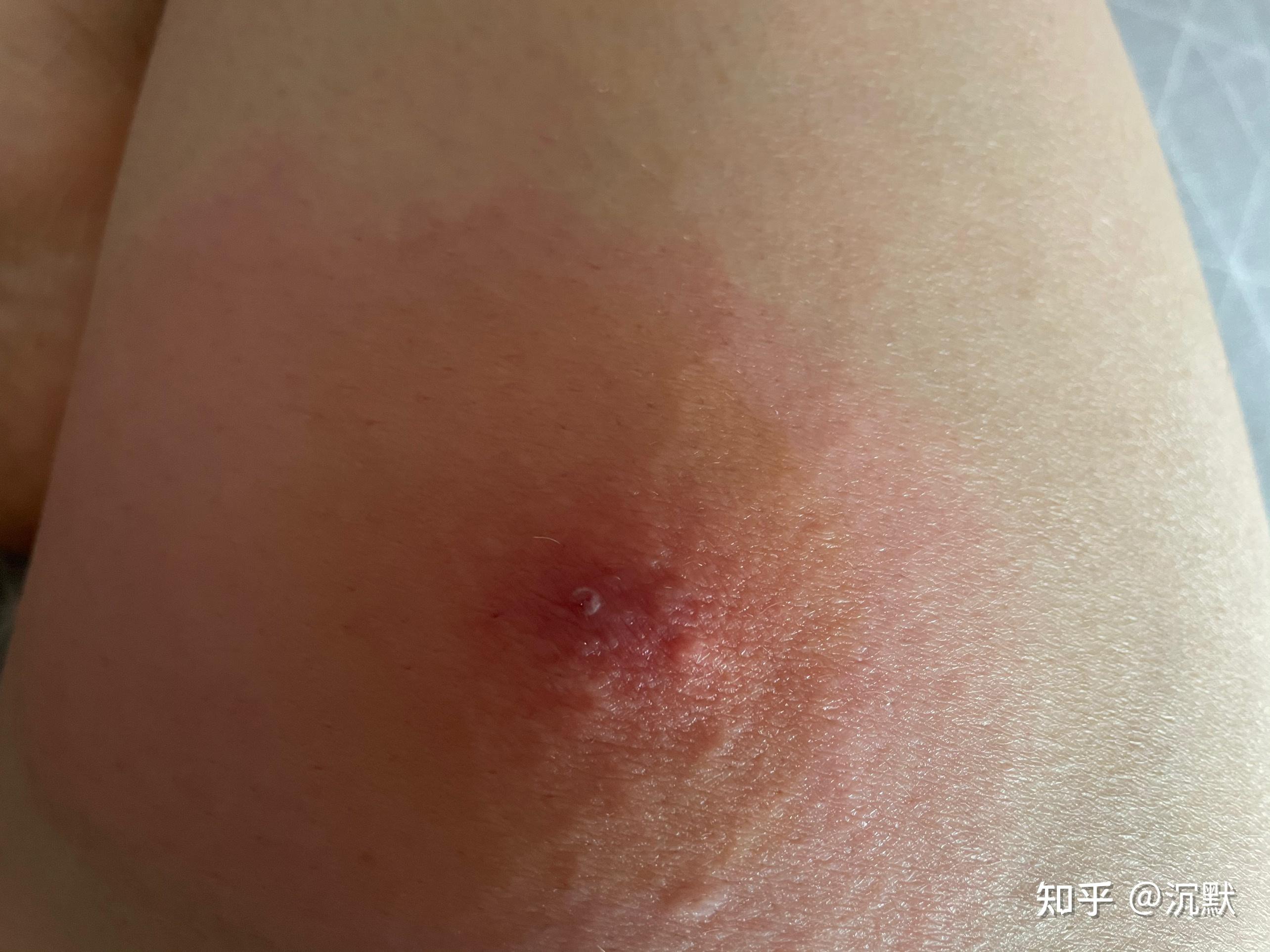 火疖子疥肿痈引流术