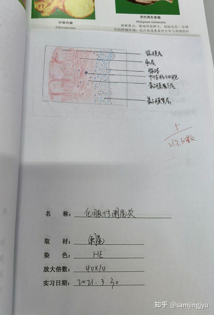 3.化脓性阑尾炎2.慢性肺淤血1.