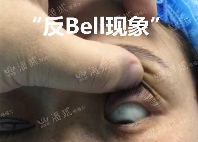 重度上睑下垂术后为什么闭不上眼睛闭眼不全怎么护理好