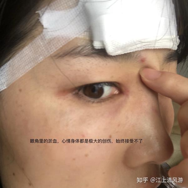 匆匆忙忙的缝了七针,我当时是拒绝缝针的… 后悔是没一点用的 我一直