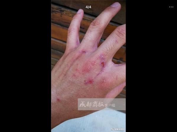 饲养员手部受伤图片