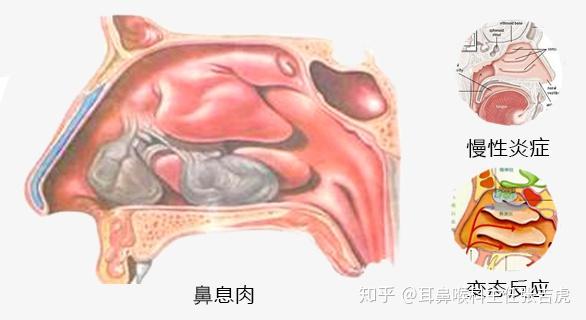 常年鼻子不透气鼻塞或是鼻息肉作怪