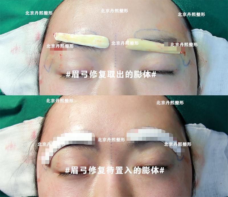 【魏洁谈眉弓】通过一例眉弓修复来了解假体丰眉弓的手术全过程