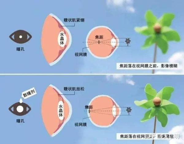 并且渐渐适应这种状态不再放松,而晶状体则变厚,仿佛给眼睛戴上了一副