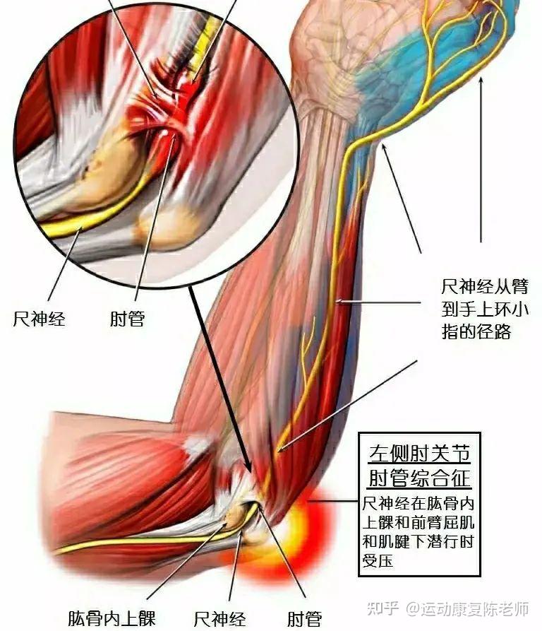腕屈肌的两个头,顶部为横跨肱骨内侧髁和尺骨鹰嘴之间的三角形弓状韧