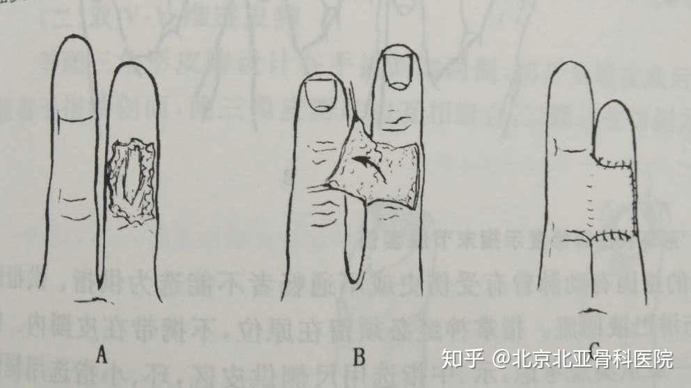 手指指端缺损局部皮瓣修复术