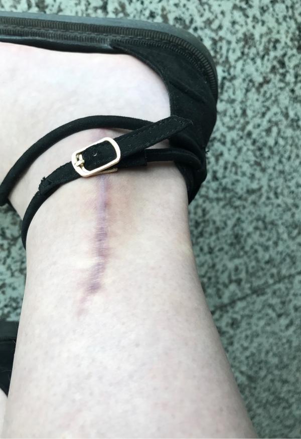 骨折是一种什么样的体验?