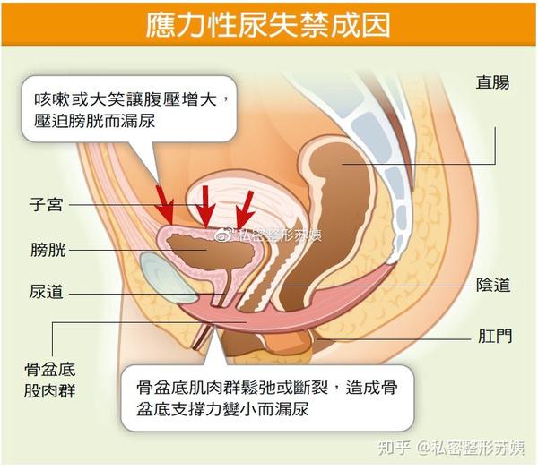 混合性尿失禁:此类疾病有时见于 年老的女性,并伴随尿潴留,患者也