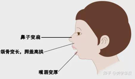 从用鼻子呼吸改成用嘴巴呼吸,,长期如此,下骨骼会往前