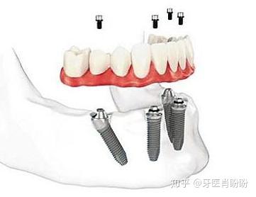 4,稳固牢靠 实际上,种植牙与真牙相同,主要包括牙冠,牙龈和基台,主要