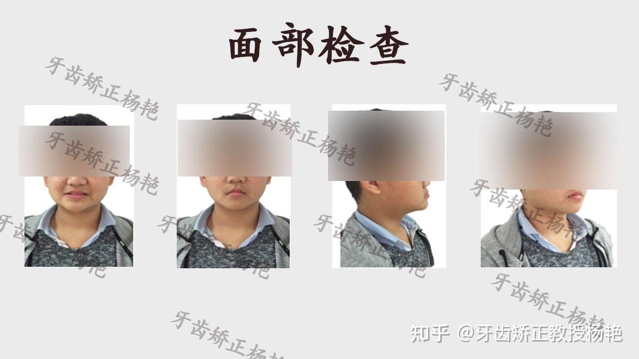 学生牙齿矫正丨高难度复杂病例骨性地包天矫治之路