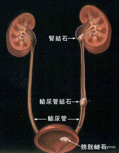 肾结石,输尿管结石亲身经历