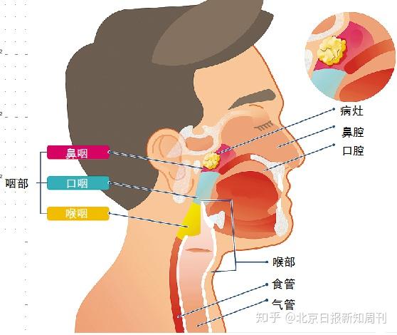 涕中带血,耳鸣耳堵,淋巴结肿大……在我国高发的鼻咽癌该如何预防?