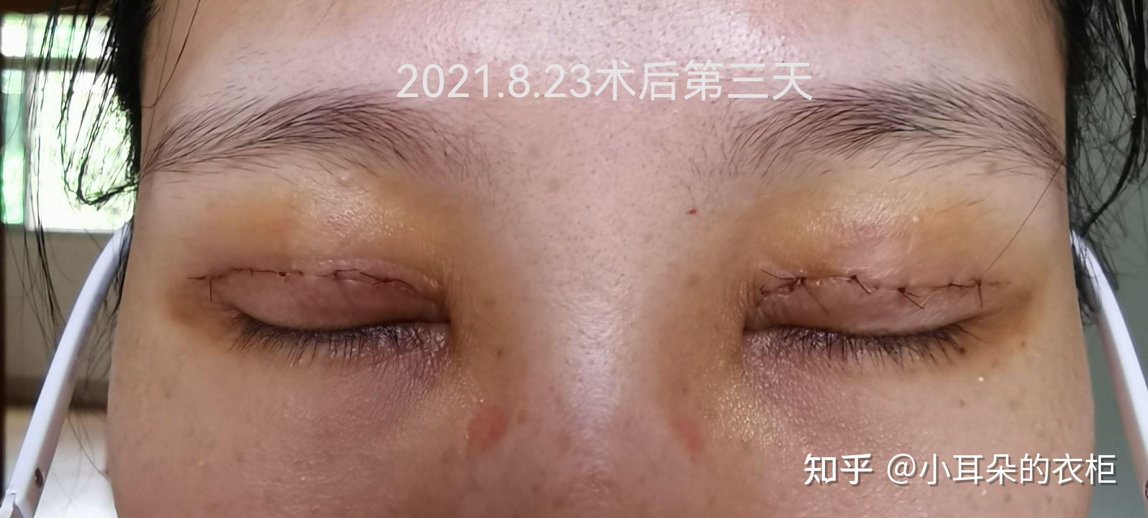 睁眼闭眼做的幅度太大,左眼伤口也被我扯裂开了一点.