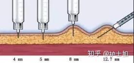 皮下注射就是打"三角肌"吗?解答皮下注射的10个临床问答