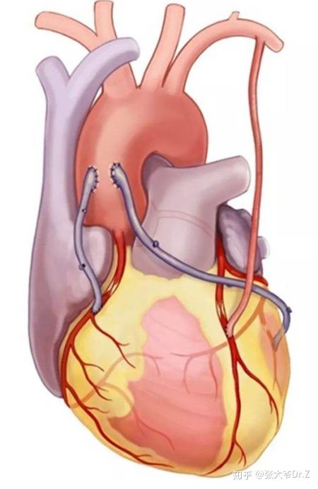 冠心病与经典的冠脉搭桥术