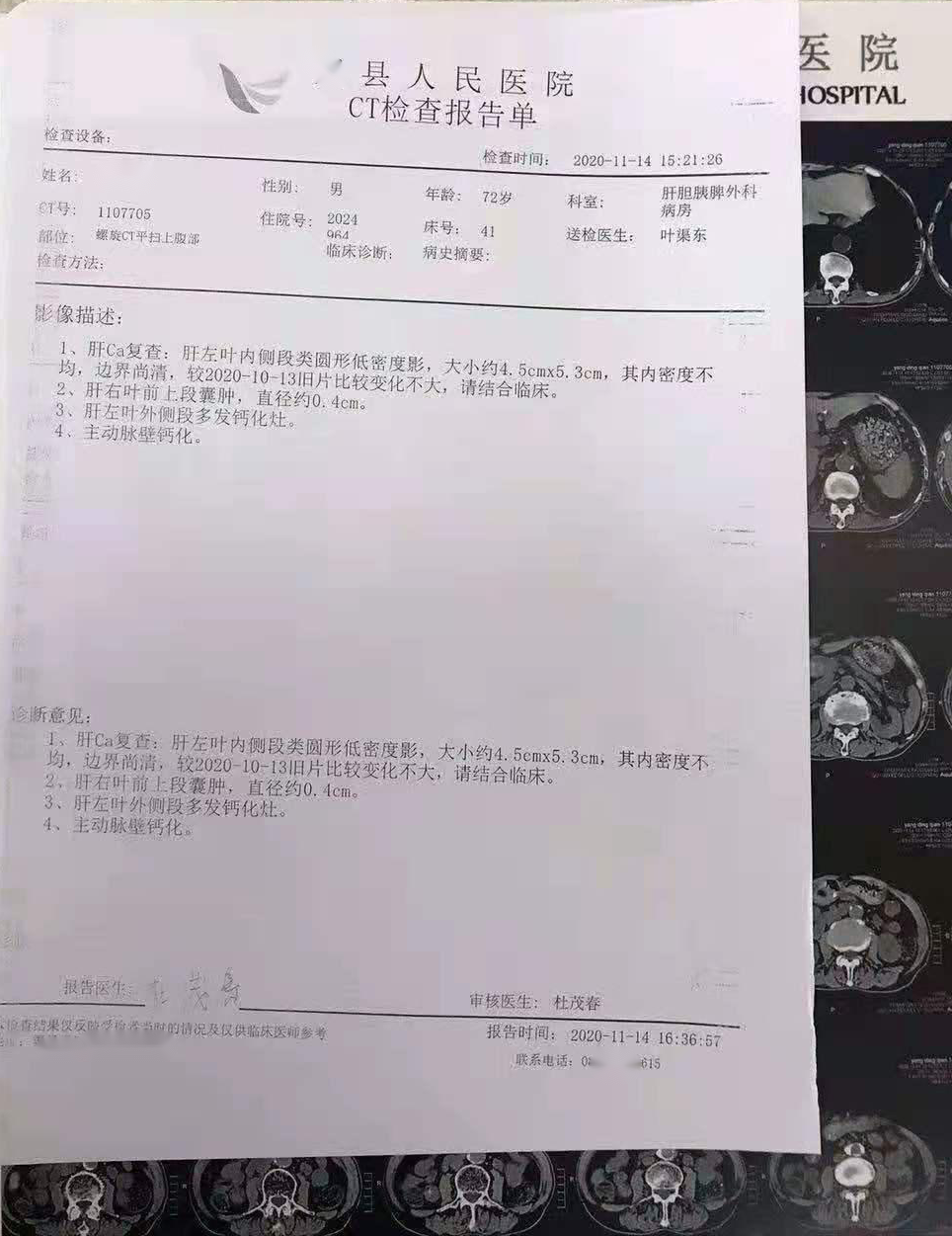 吴孟达确诊肝癌到去世不到3个月这位肝癌患者肿块却缩小了近一半治疗