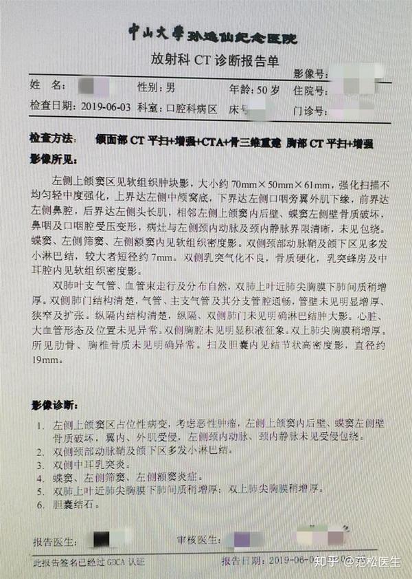 病例分享丨鼻咽癌放疗诱导的左上颌颅底骨肉瘤