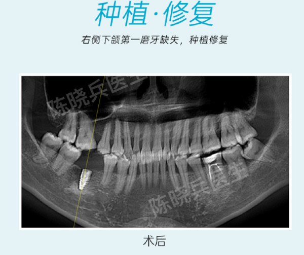广州种植牙-陈晓兵-右侧下颌第一磨牙缺失6个月-种植案例