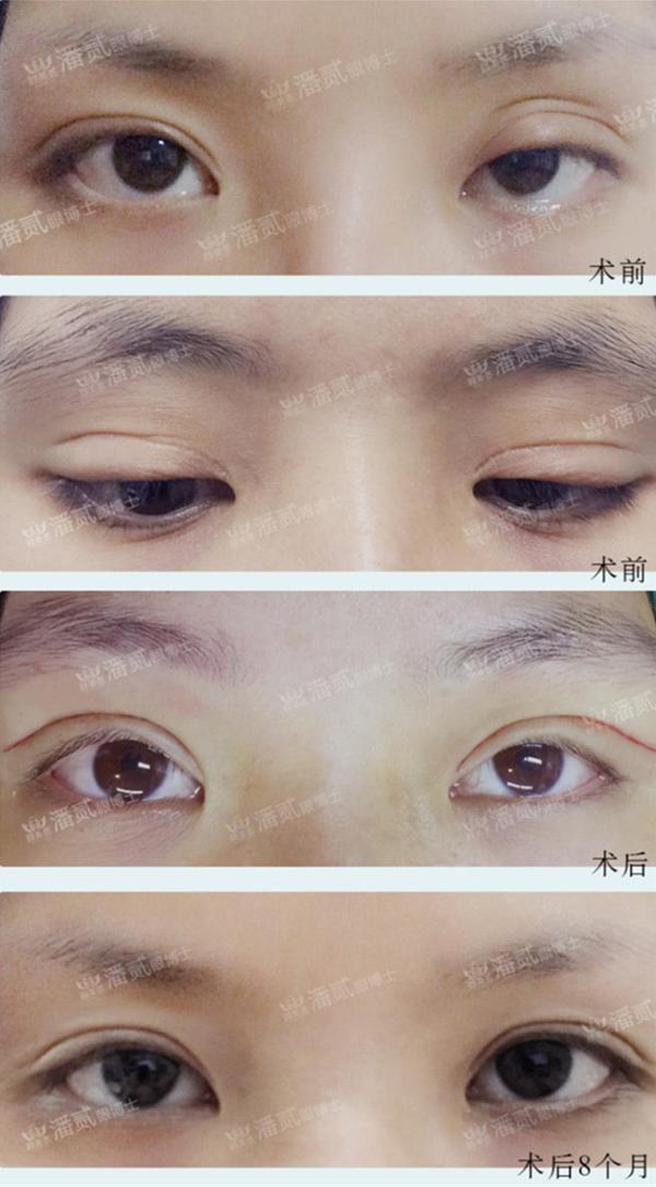 你觉得我的双眼皮失败了吗需不需要进行修复多久修复比较好