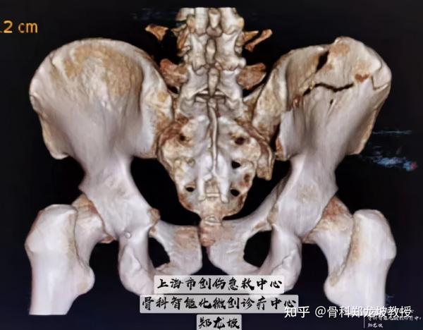 骨盆三维ct重建后面观,右侧髂骨后部骨折,骶髂关节分离