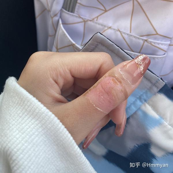 手指二度烫伤的愈合及恢复过程持续更新ing