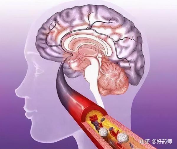 脑梗已成为我国国民第1位的死亡原因提醒秋冬季高发期