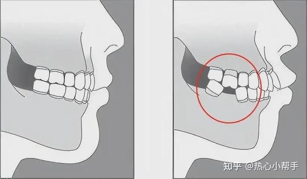 咬合关系破坏,需要咬合重建