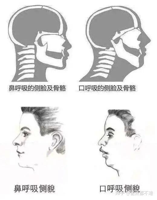 长期口呼吸对容貌的影响