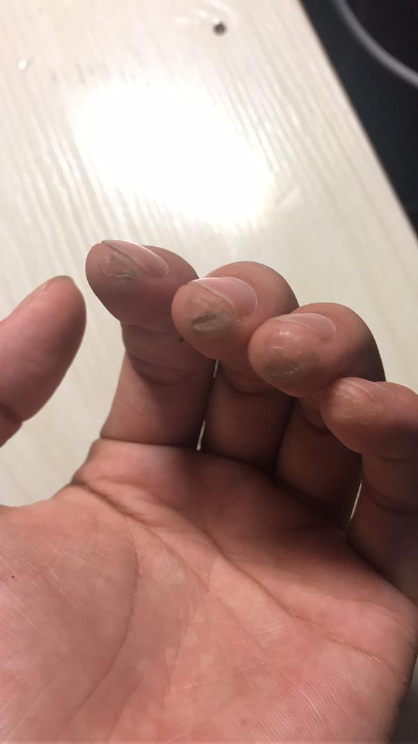想知道学吉他的吉友们,你们的左手手指的情况?剖出图片来.