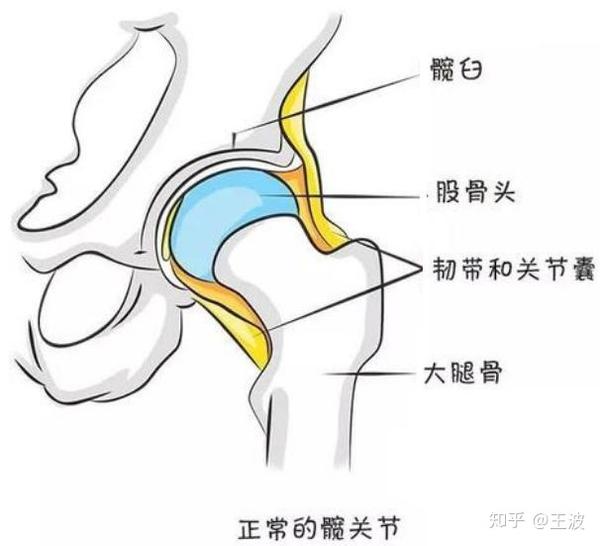 什么是成人髋关节发育不良