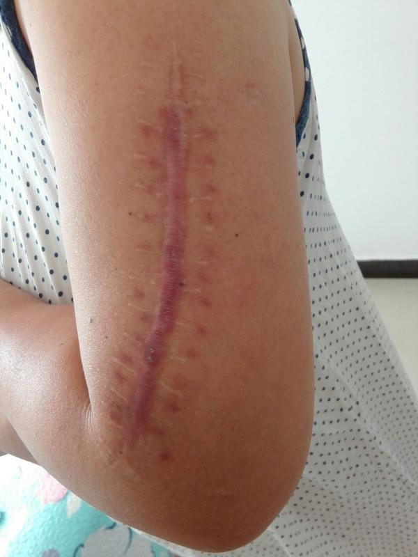 求祛疤痕好药 做了取钢板的手术 缝了15针 疤痕很丑?
