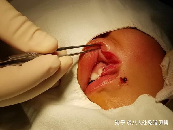 口腔贯通伤美容外科缝合