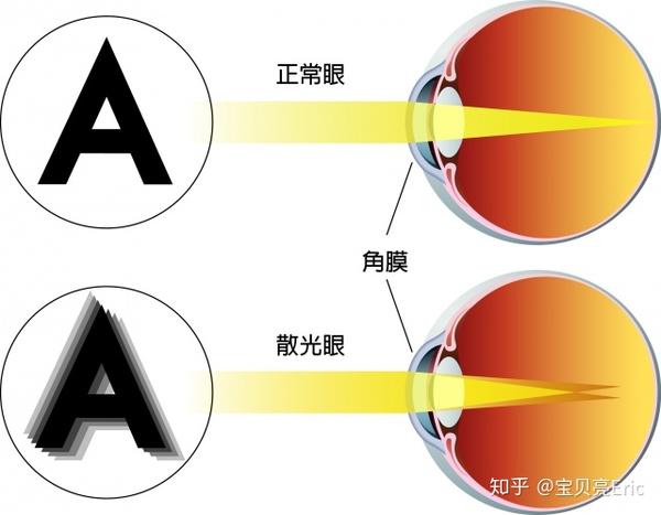 散光是什么意思?