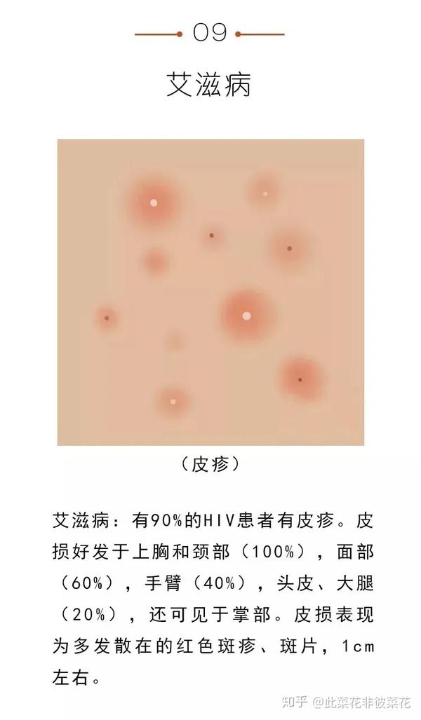 图解湿疣疱疹梅毒性病到底长啥样