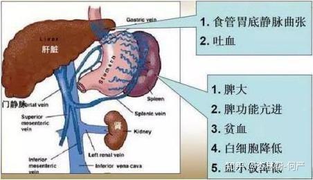 名医访谈|上海东方肝胆外科医院夏勇:肝硬化门脉高压症诊断治疗